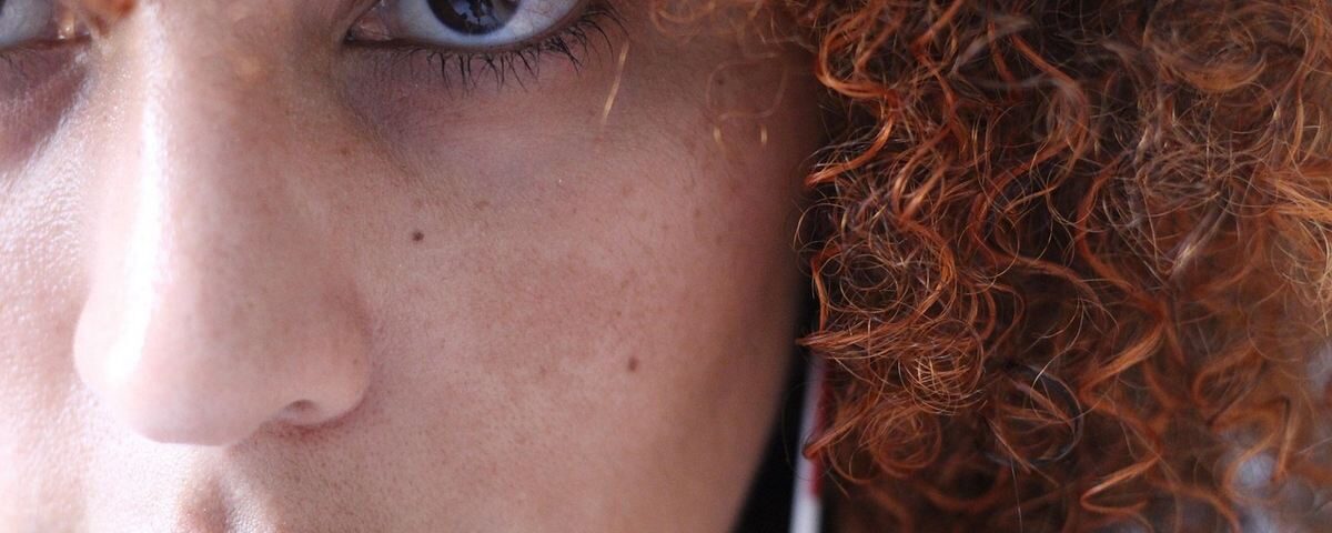 O que é Melasma